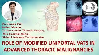 ROLE OF MODIFIED UNIPORTAL VATS IN ADVANCED THORACIC MALIGNANCIES  DR Deepak Puri  Max Hospital [upl. by Nojad]