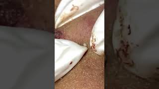 Big Cystic Acne Blackheads Extraction Blackheads amp Milia Whiteheads Removal Pimple Popping [upl. by Jillane]