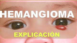 Qué es un hemangioma infantil [upl. by Averill]