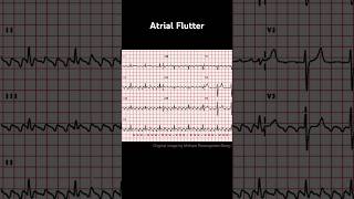 Atrial Flutter ECG with 41 AV conduction ratio [upl. by Endor]