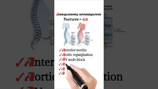 Features of Ankylosing Spondylitis [upl. by Attelrak]