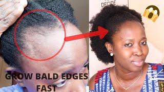 THIS TREATMENT WILL GROW amp TREAT YOUR BALDNESS amp THIN EDGES FAST IN 1 MONTHUse 3 times weekly [upl. by Elwyn]