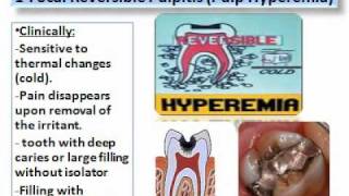 Pulp Diseases Oral Pathologywmv [upl. by Eupheemia386]