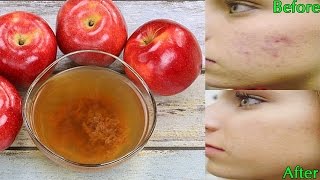 What Will Happen If You Drink Apple Cider Vinegar Daily [upl. by Eatnwahs333]