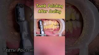 Teeth Polishing Procedure  Teeth Polishing Before and After  Teeth Cleaning dentalhygiene shorts [upl. by Benenson]