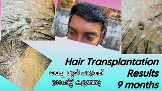 Hair Transplantation result 9 month  ഒരു ഗ്രാഫ്റ്റ് പറിച്ച് കളഞ്ഞു  safvan pullara [upl. by Sachiko823]