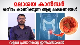 മലാശയ കാൻസർ ശരീരം കാണിക്കുന്ന ആദ്യ ലക്ഷണങ്ങൾ  Colon cancer Malayalam  Dr Shabeer Ali  KIMS HEALTH [upl. by Elehcor729]