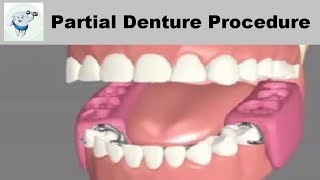 Removable Partial Dentures Steps [upl. by Marketa]