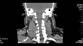 case 10  hoarseness of voice [upl. by Rafferty]