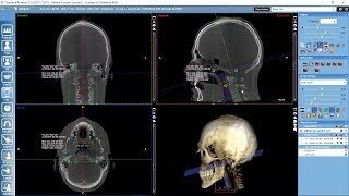 Planmeca Romexis segmentation tools [upl. by Rosenkrantz]