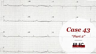 EPEC​​​ ECG Cases Case 43 part 2 Why not IRAVD [upl. by Annaet]