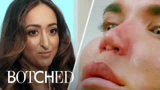 The Most Intense Nose Surgeries From Botched  E [upl. by Ynahpets]