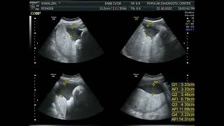 How to measure AFI [upl. by Kered135]