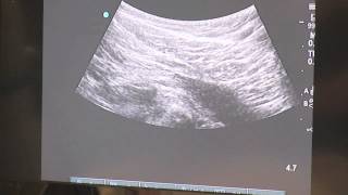 Trigger Point Injections  Ultrasound Guided [upl. by Adnawot]