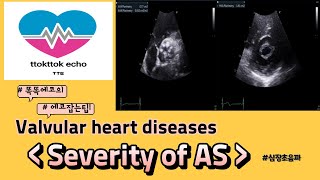 Severity of AS aortic stenosis AS  VHD echocardiography 심장초음파 heart echo view [upl. by Roti]