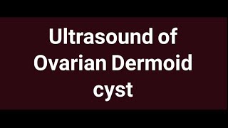 Ultrasound of Ovarian Dermoid Cyst [upl. by Isa229]