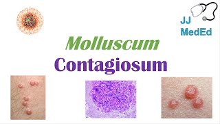 Molluscum Contagiosum “Papules with Belly Buttons” Risk factors Symptoms Diagnosis Treatment [upl. by Sparky]