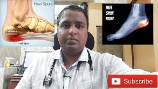 HEEL PAINCALCANEAL SPUR TREATMENTएड़ी के दर्द का इलाज [upl. by Michale645]