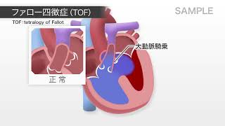 目で見る病気 第3版 VOL8 循環器系の疾患（ファロー四徴症） [upl. by Dao]