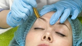 Microdermabrasion amp Acne Scars  Acne Treatment [upl. by Nosnek]