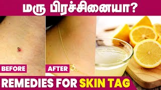 How to remove Skin Tag at Home  Skin Maru Removal Tamil [upl. by Ennovehc]