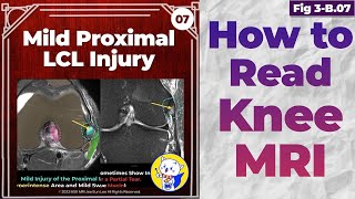 Fig 3B07 Mild Proximal LCL Injury [upl. by Ahsiet]