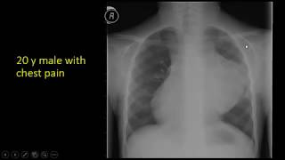 Case discussion 1 FRCR session5 Dr Amr Saadawy [upl. by Vona]