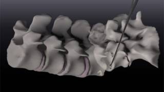 Posterior lumbar interbody fusion PLIF at L45 [upl. by Fedirko]