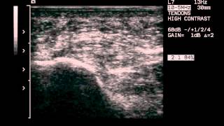 plantar fascia infiltrationwmv [upl. by Nehtanoj]