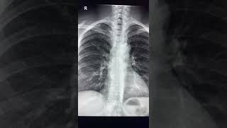 Right cardiophrenic angle opacity  Most common cause [upl. by Eico]