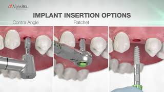 AlphaBio Tec Implant Package [upl. by Irehc]