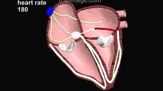 Wolff Parkinson White Syndrome Animation by Cal Shipley MD [upl. by Florio109]