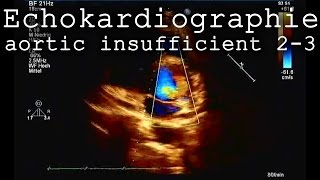 Herzecho Aorteninsuffiziens Grad 23 bikuspide Herzfehler aortic echo  cardiacdefect [upl. by Meehaf]