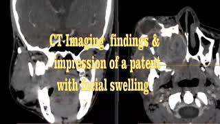 Maxillary mass [upl. by Rhines]