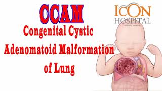 CCAM  Congenital Cystic Adenomatoid Malformation  of Lungs [upl. by Lilhak]