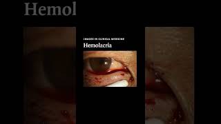 Hemolacria  NEJM [upl. by Dole]