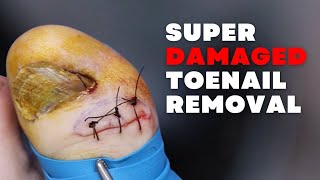 Super DAMAGED Toenail REMOVAL [upl. by Eibrab]