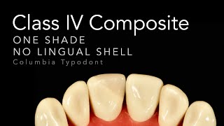 Class IV Composite Restoration  Step by Step One Shade Class IV Restorations [upl. by Nnylg900]