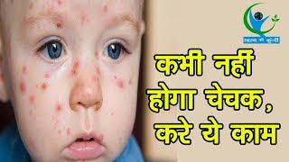 चेचक रोग से बचने के घरेलू उपाय  Smallpox – Chicken Pox – Natural Home Remedies [upl. by Annaiuq]