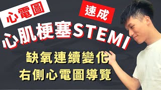 【8分鐘搞定心肌梗塞心電圖】STEMI ECG實際案例導覽！心肌梗塞臨床症狀、右側心電圖判讀、ACLS、前壁梗塞、側壁梗塞！醫學生臨床值班必備技能！心肌缺氧連續性心電圖變化、十二導程心電圖、課後測驗！ [upl. by Htieh825]