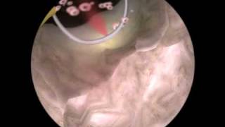 Bleeding Control Coagulation TURP Prostate Resection [upl. by Wane]