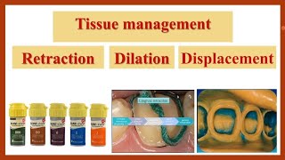 Tissue Management Gingival Retraction طرق ومواد ابعاد اللثة عن السن [upl. by Sina]