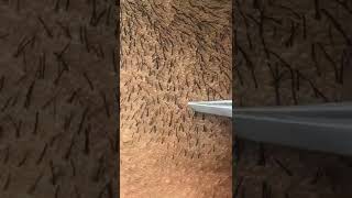 Two hairs in one follicleplucking ingrown hairsshorts [upl. by Hines154]