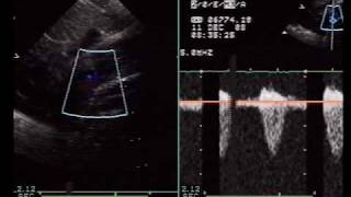 Severe Coarctation of the Aorta [upl. by Ydarg]