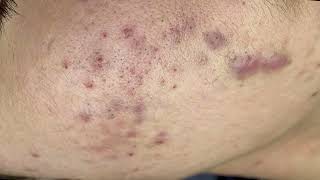 Loan Nguyen Acne Treatment 15d [upl. by Cyndie]