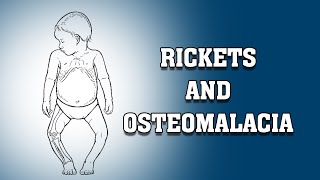 RICKETS AND OSTEOMALACIA [upl. by Ayle]