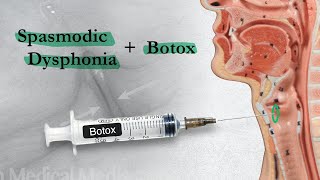 Spasmodic Dysphonia  When Botox Disappoints  Part 2 [upl. by Idonna411]