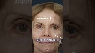 Facelift vs Mini Facelift Understanding the Difference  Dr David Stoker [upl. by Noremac]