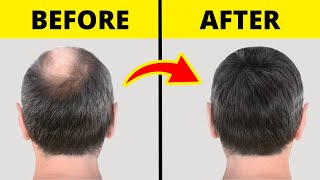 10 Guaranteed Ways to Regrow Hair Fast  🚫 No Surgery [upl. by Najib956]