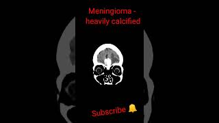 Meningioma heavily calcified shorts trending education [upl. by Ahsinhoj]